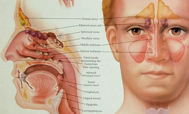 Sinus surgical treatment for fungal contamination nasal polyps and yeast infection